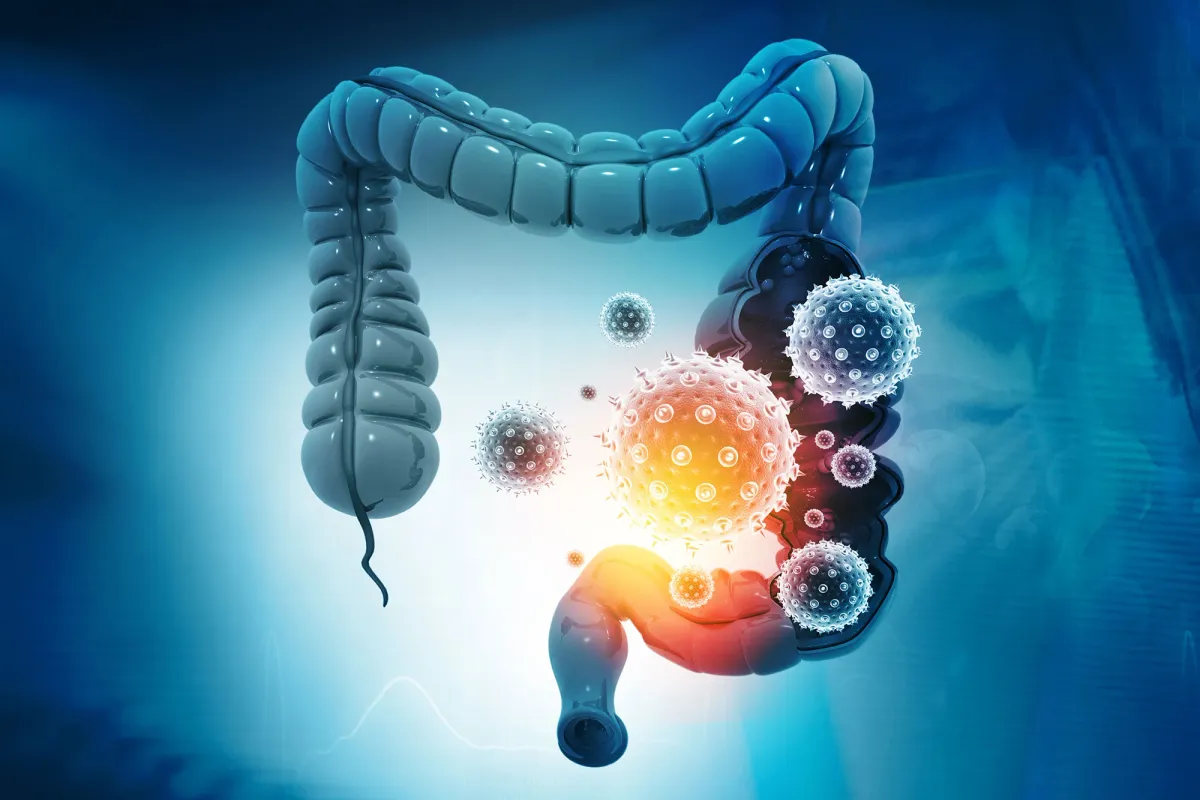 The Immune Chain Reaction That Raises Colon Cancer Risk in IBD