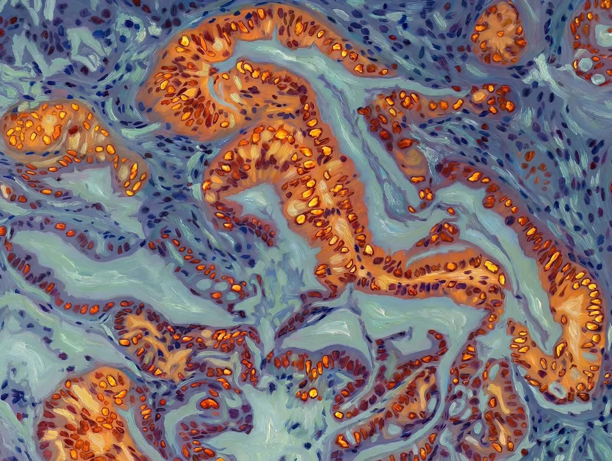 Scientists find the switch that makes pancreatic cancer treatable again