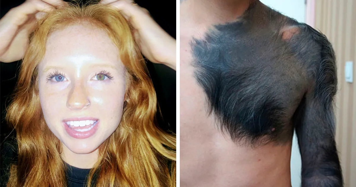34 People Whose Genetics Made Them Unique