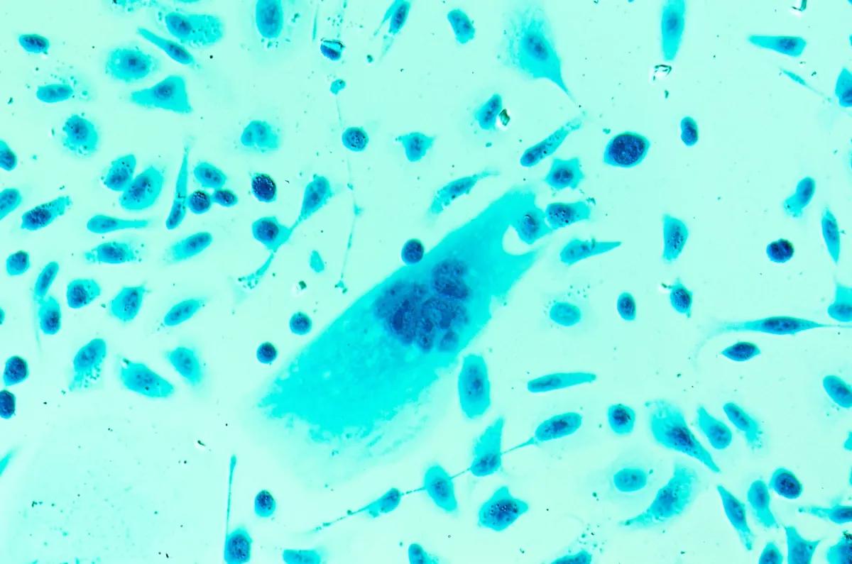 New drug shows tumor shrinkage in men with advanced prostate cancer