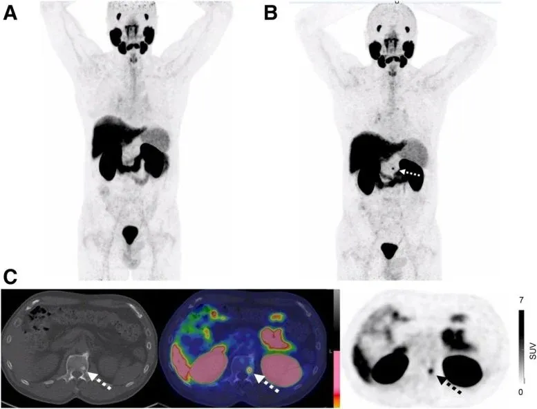 Second Scan Finds Hidden Prostate Cancer in Over Half of Patients