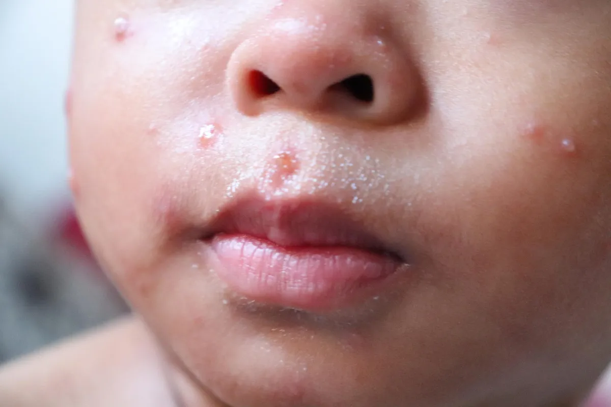 Scientists Discover Immune Cells That Can Fight Both Measles and Nipah
