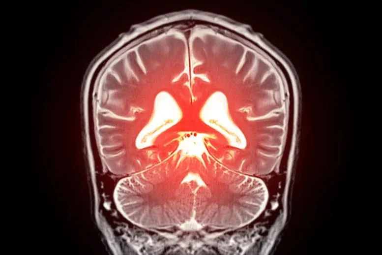 Hidden Brain Wiring May Help Preserve Thinking As Gray Matter Shrinks