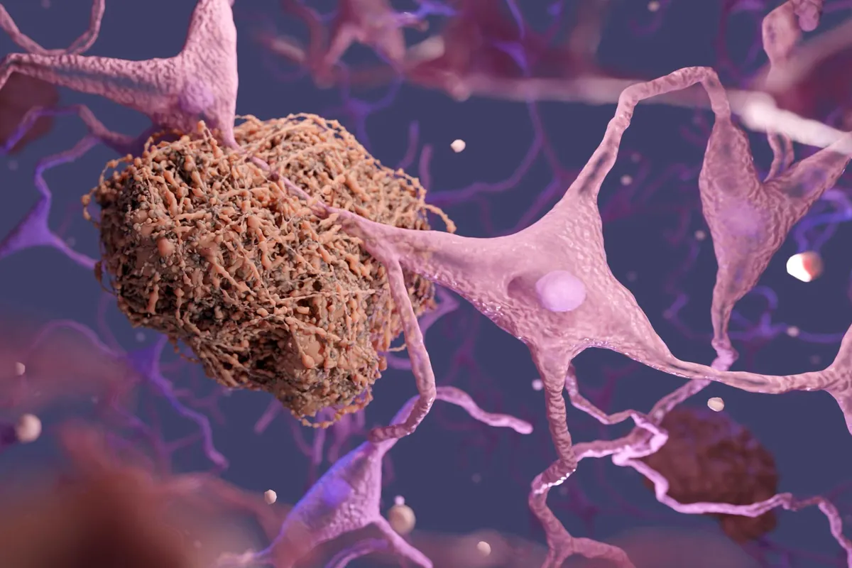 Researchers watch Alzheimer's proteins clump, then reverse the process