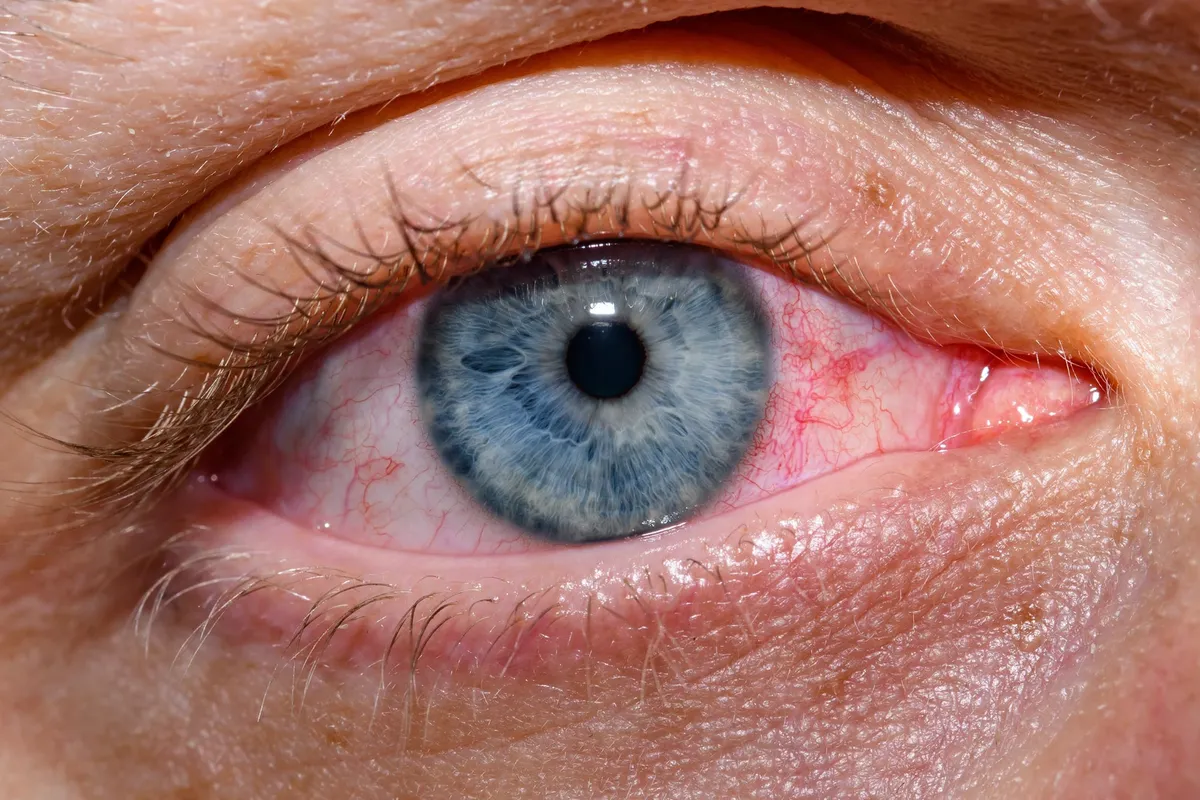 Scientists Develop Experimental Eye Drop That Could Transform Dry Eye Treatment