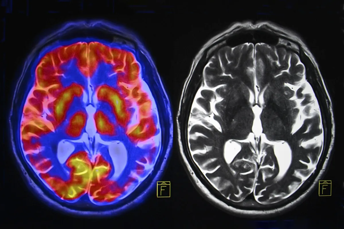 Researchers Suspected Brain Inflammation in Long COVID but Found Something Else