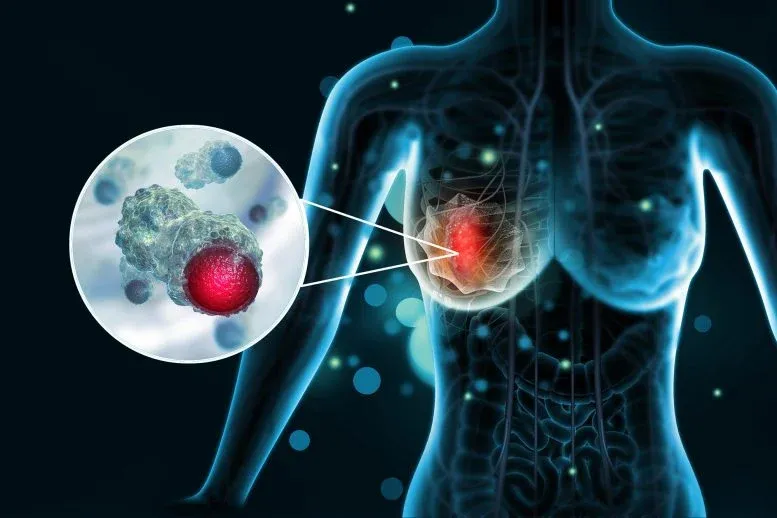 Those Weight-Loss Shots? They Might Also Slash Breast Cancer Risk.