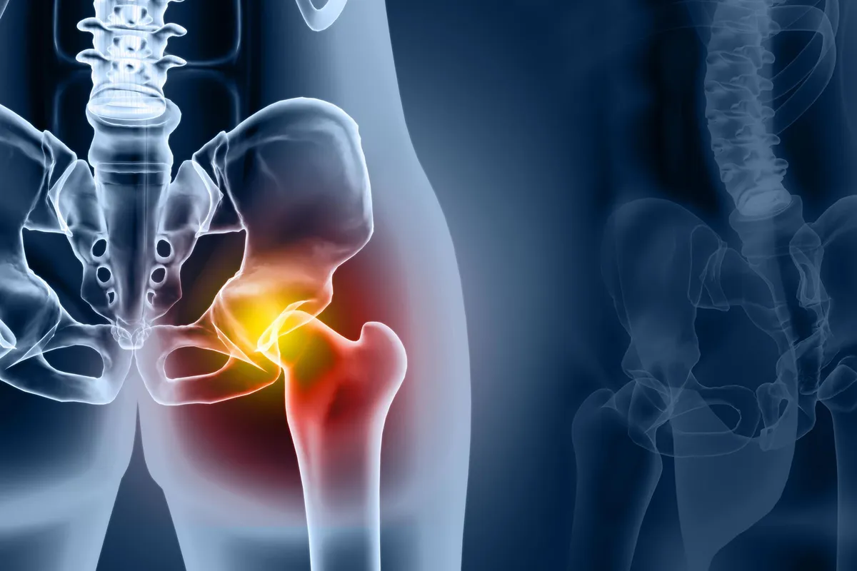Hip Replacements Are Lasting Far Longer Than Doctors Once Thought