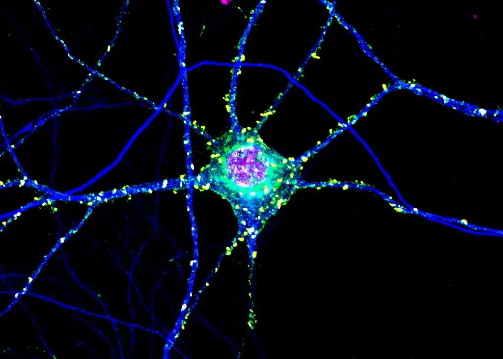 Toxic Clumps in Huntington’s Disease May Protect the Brain Too
