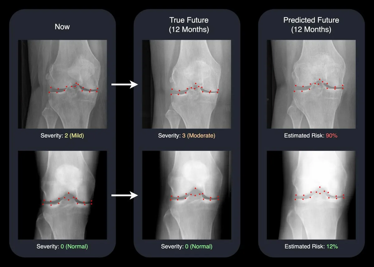 AI Brings Tomorrow’s X-Rays to Life, Helping Doctors Fight Arthritis Sooner
