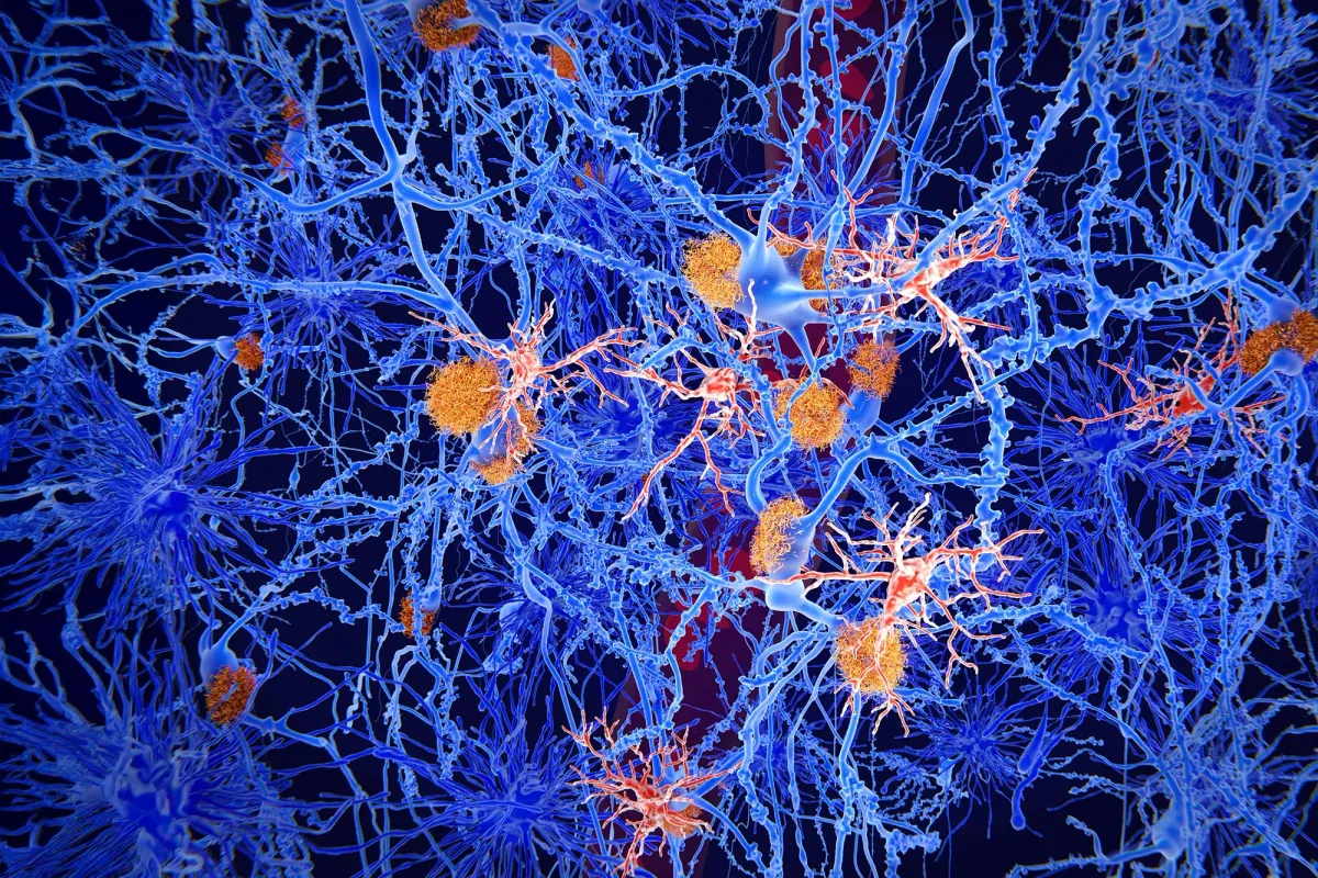 Scientists Uncover a Hidden Early Stage of Alzheimer’s That They Can Stop