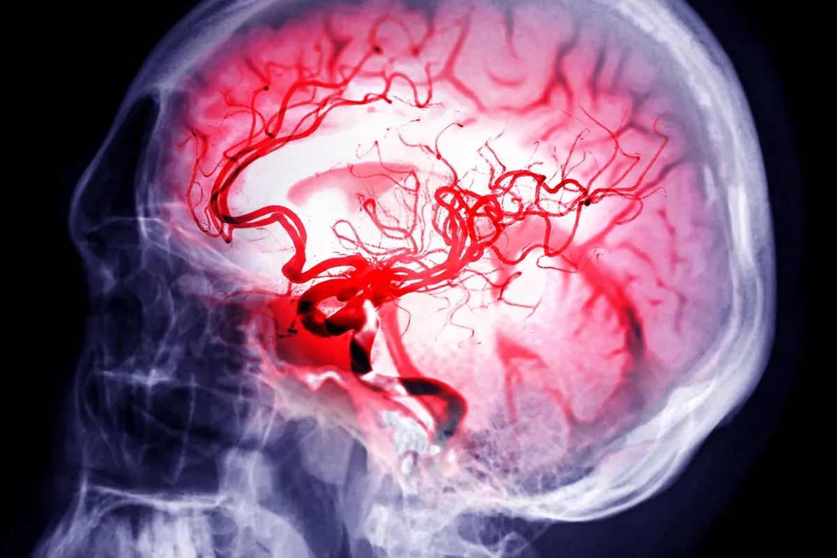 Testosterone, The Unlikely Hero, Could Protect Against Brain Cancer