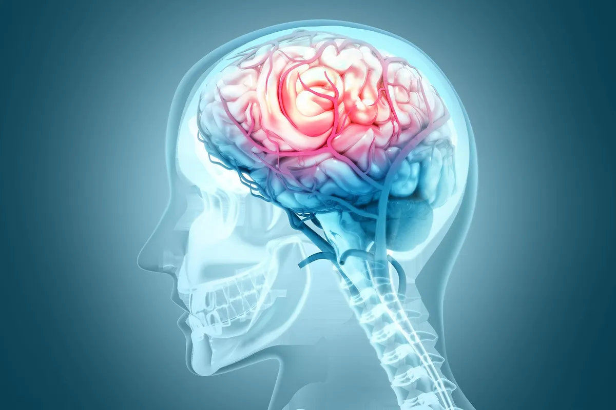 This Brain Condition Quadruples Dementia Risk And Most People Have Never Heard of It