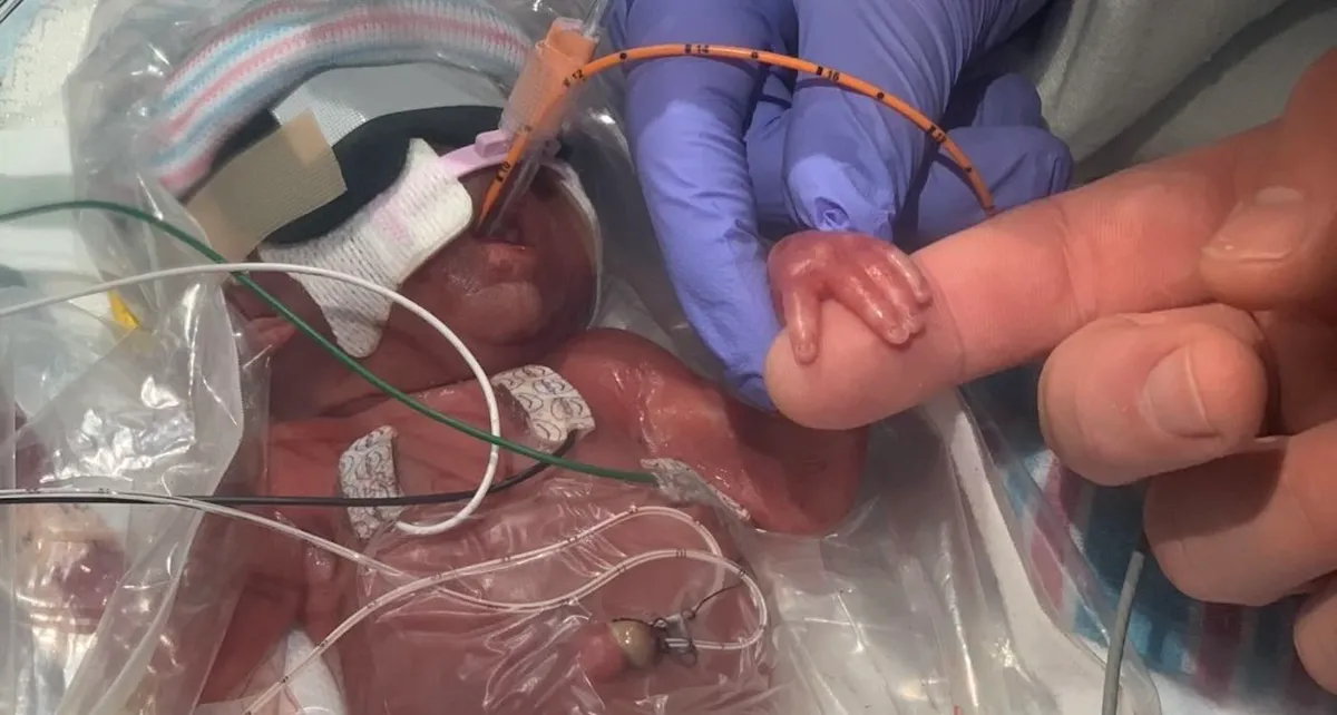 Miracle Preemie Shatters Odds, Defies Tiny Hands to Thrive at Home