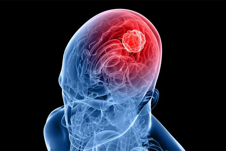Scientists Found a Glioblastoma Weak Spot. It's One Protein.
