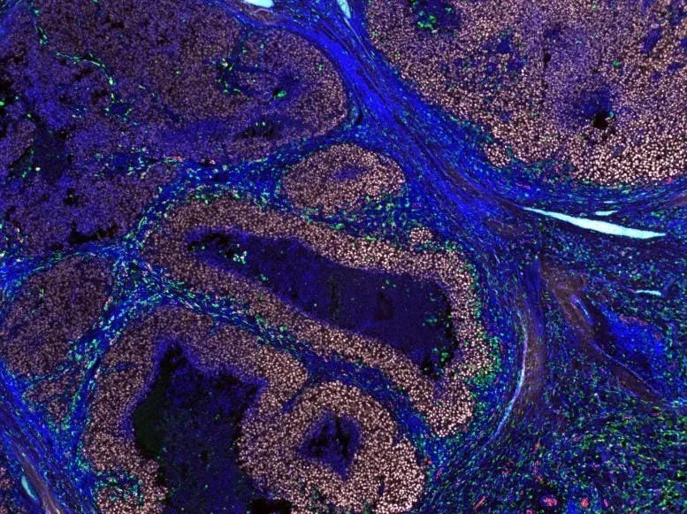 A highly magnified view of a human melanoma tumor. Here, you can see the protective ‘housekeeping’ immune cells called CD169+ macrophages (highlighted in bright green and red) positioned right up against the cancer cells (in pink), ready to attack and engulf them.