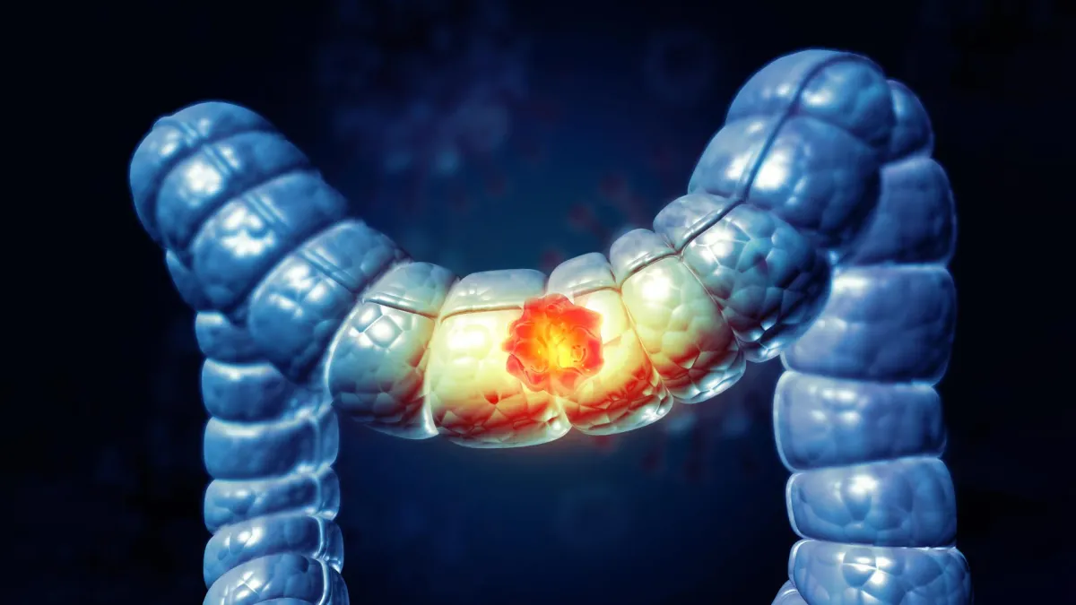 A Nine-Week Treatment Kept Colon Cancer Away for Nearly Three Years